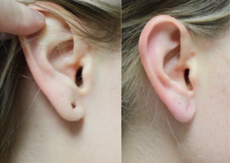 Earlobe repair before and after result at Newport Faces