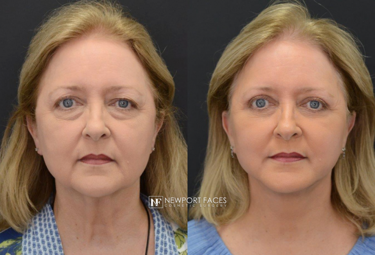 Facelift before and after patient collage at Newport Faces