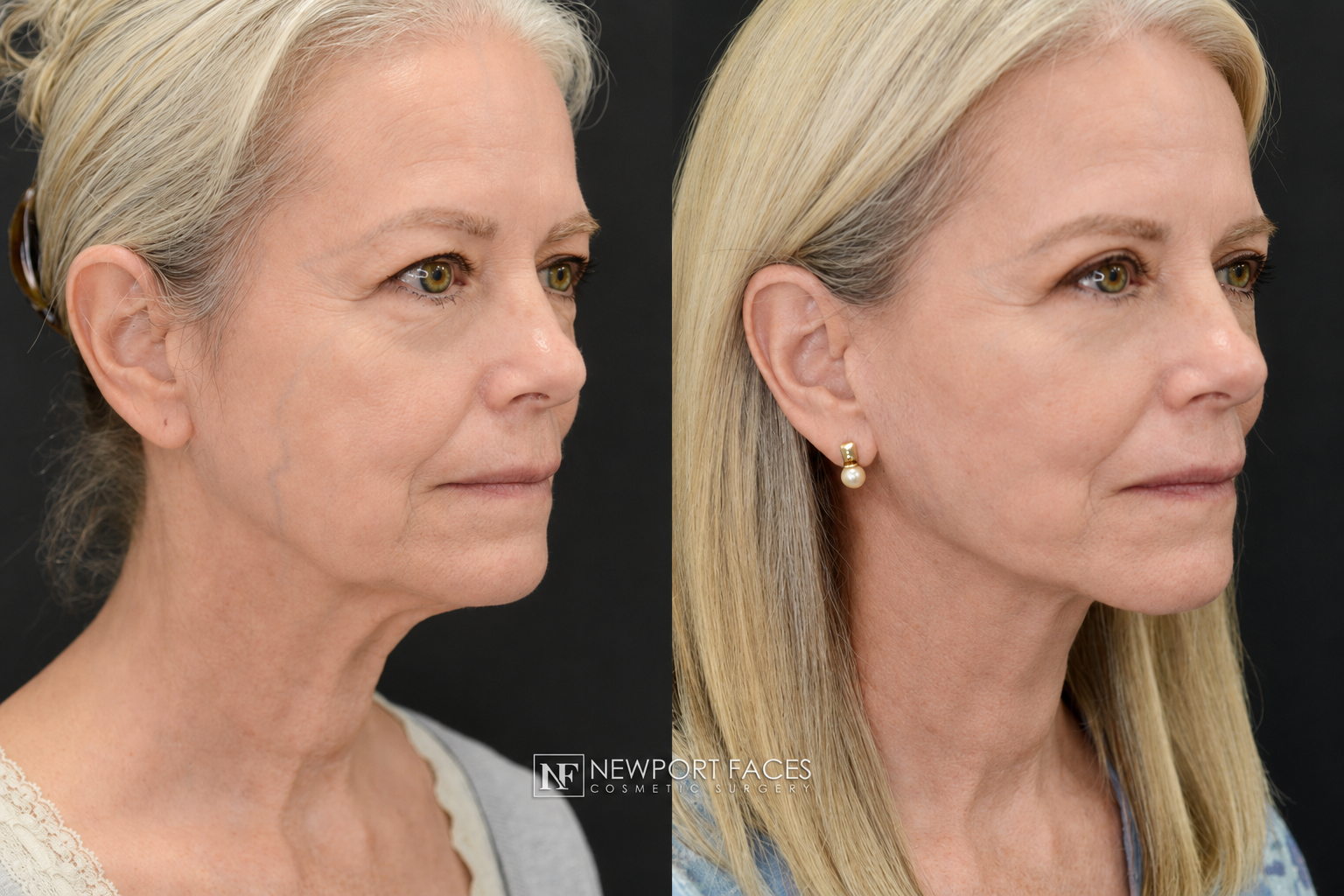Three-quarter-view facelift before-and-after result from Newport Faces