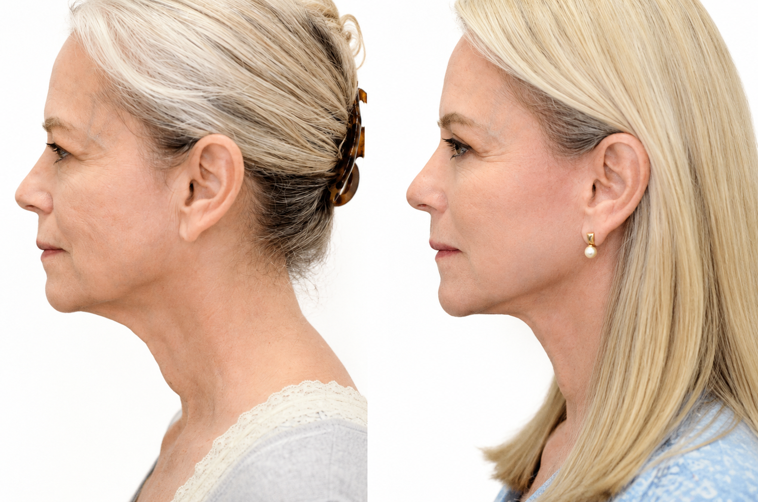 Profile-view facelift before-and-after result showing jawline and neck definition