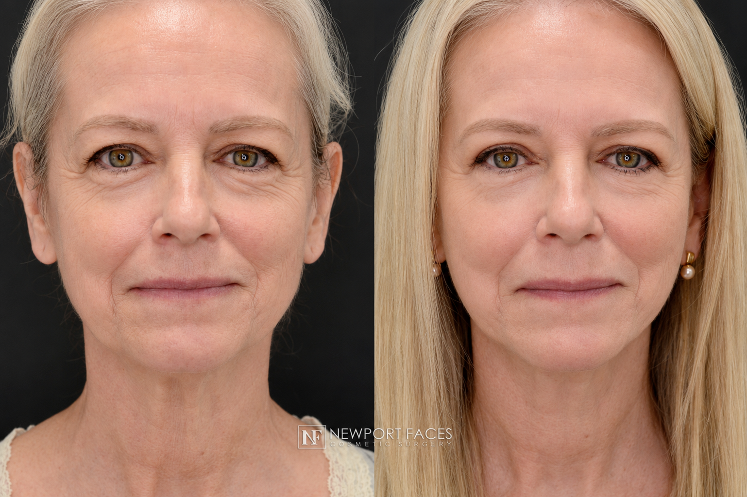 Front-view facelift before-and-after result from Newport Faces