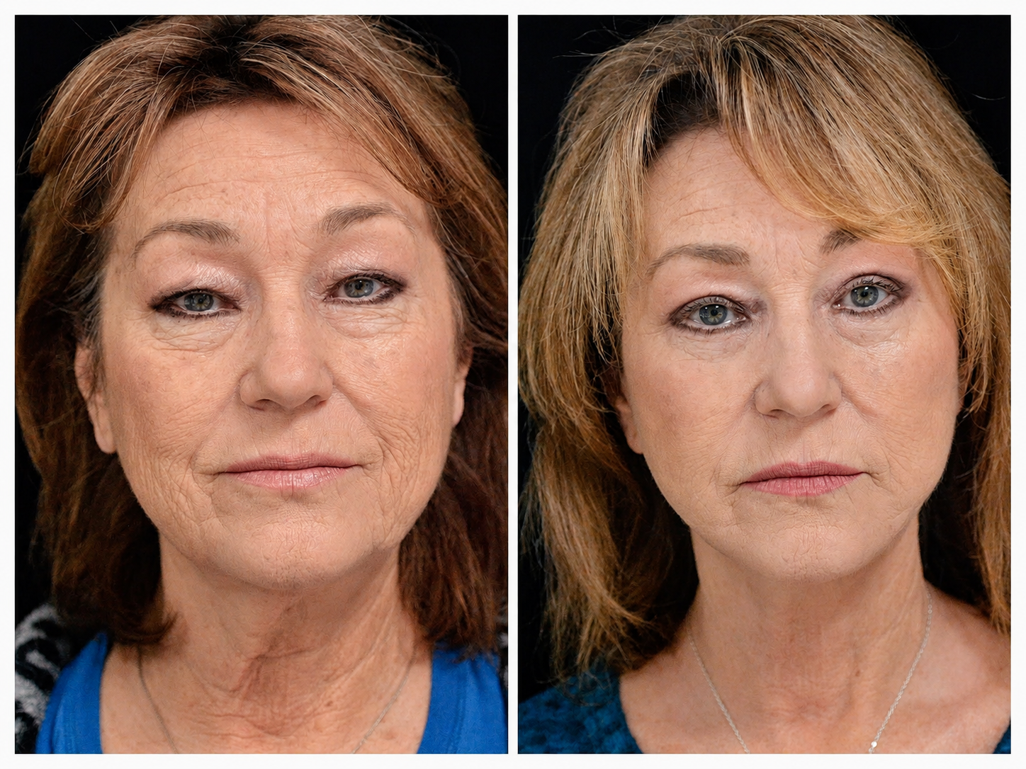 Newport Faces facelift before and after result